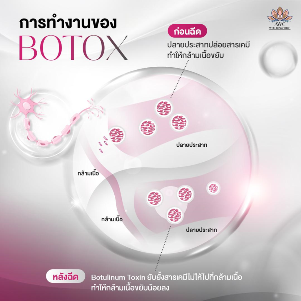 Botulinum Toxin A